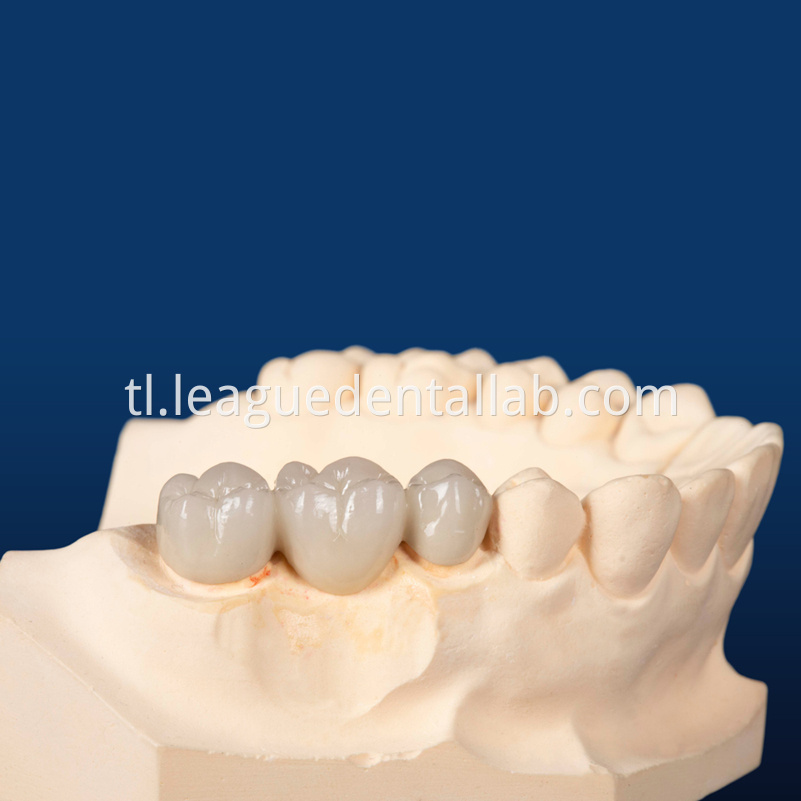 PFM,Metal crown,Fixed metal crown